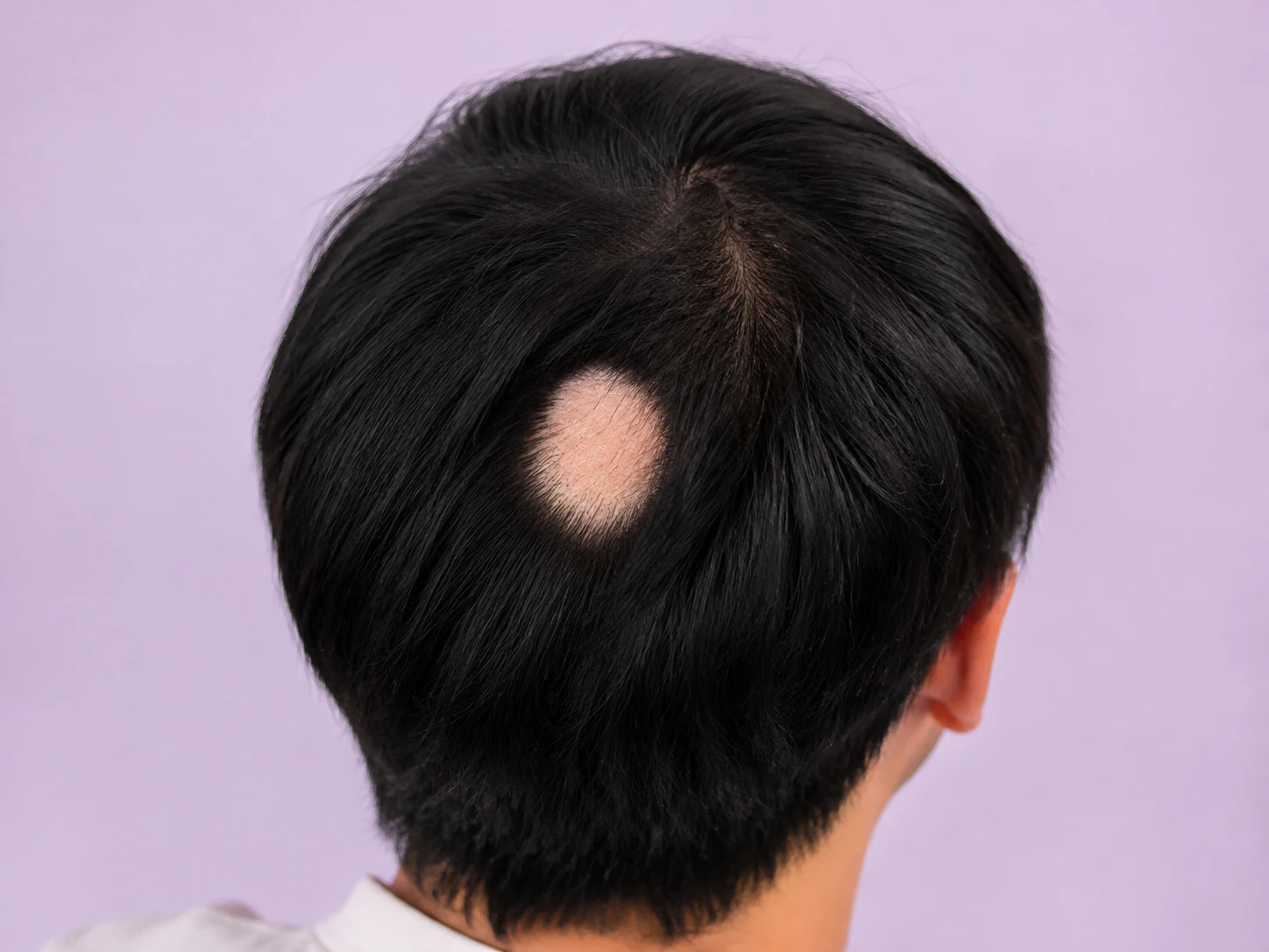 斑禿